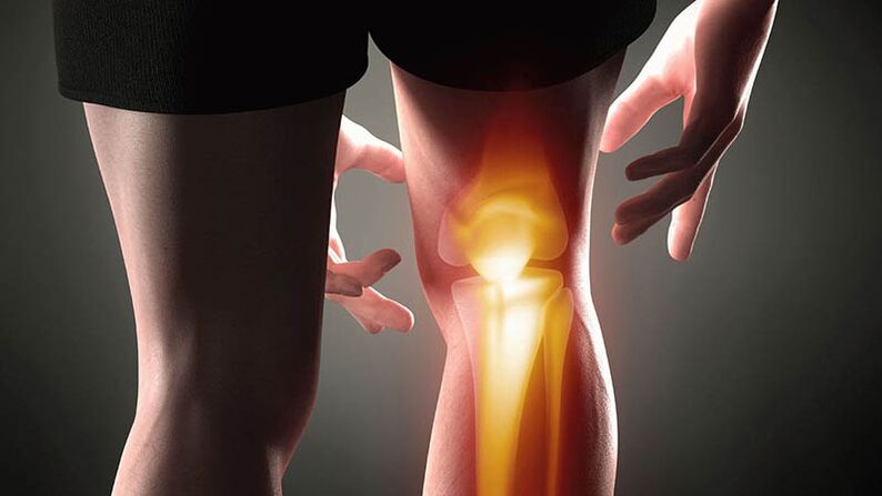 Arthritis of the knee joint