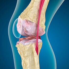 Excessive thigh muscle tension provokes knee pain