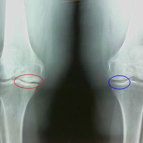 Knee joint arthrosis in radiographs